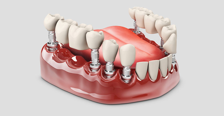 Dental Crown and Bridge