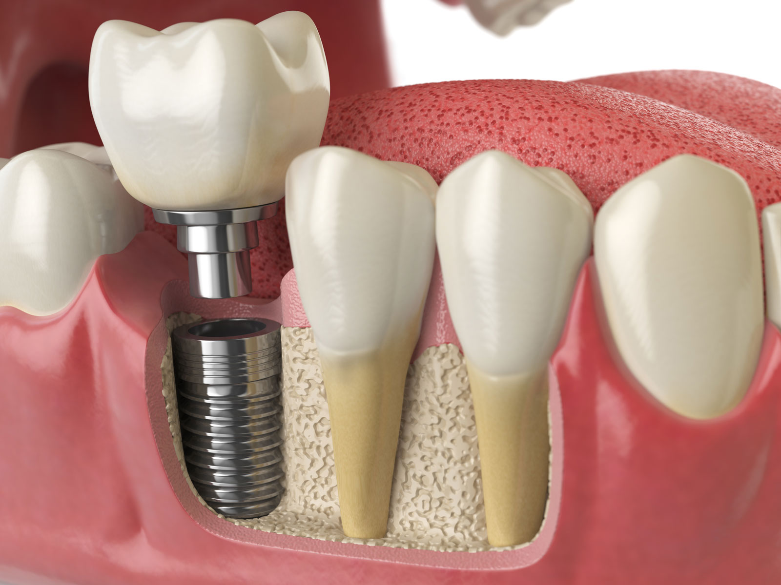 Dental Implants at Traviesas Dental Care
