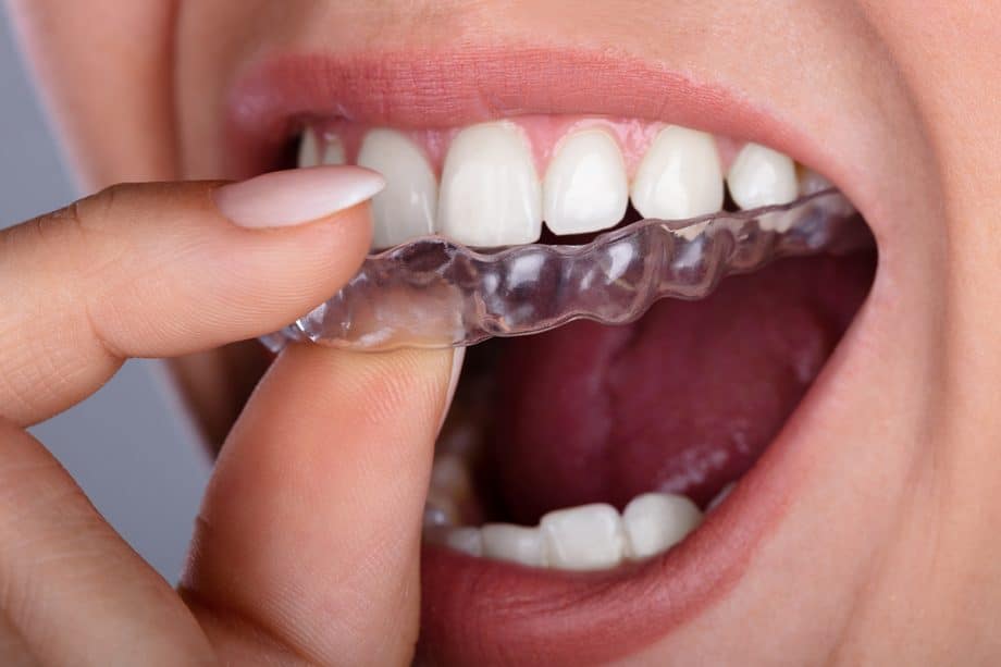 Invisalign Clear Aligners