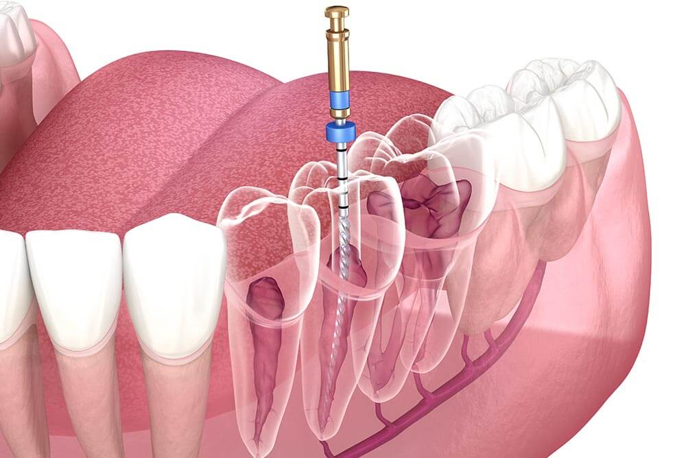 Root Canal Treatment